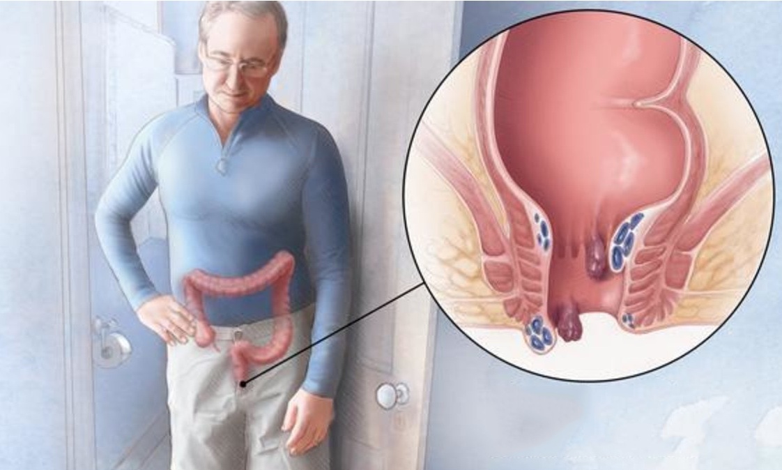 Thuốc thực phẩm chức năng hỗ trợ điều trị bệnh trĩ an toàn tại Hà Nội | Giá tốt