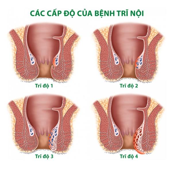 Review TOP 3 loại TPCN & thuốc trị bệnh trĩ hiệu quả tại Hà Nội